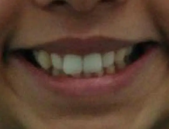 Invisalign