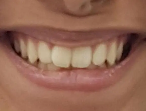 Invisalign