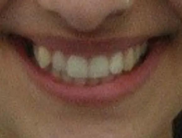 Invisalign