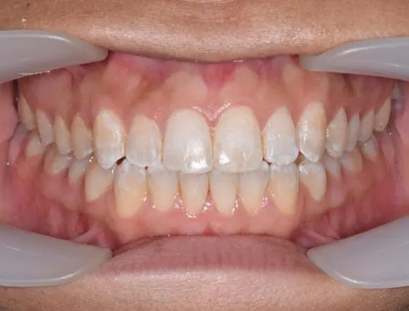 Invisalign