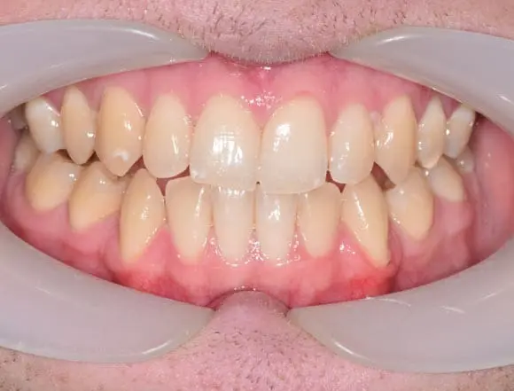 lingual braces