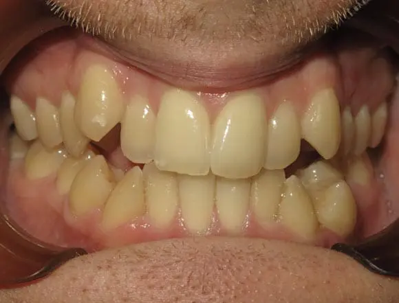 lingual braces