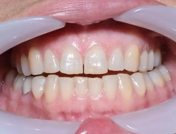 Whitening & Composite Bonding