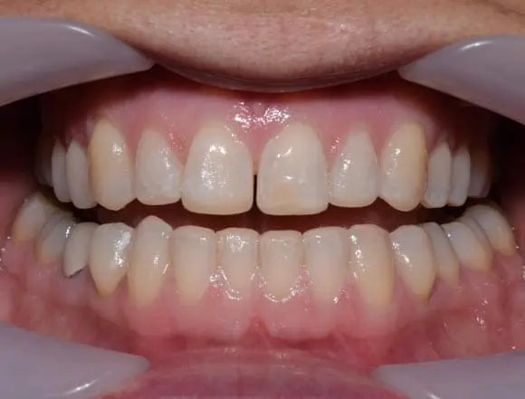 Whitening & Composite Bonding