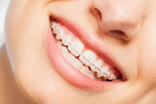 ceramic braces and smile