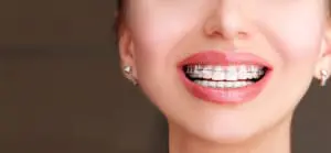 Ceramic Braces