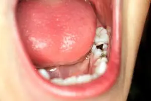 Tooth Decay