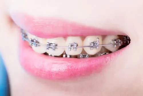 Invisalign or fixed braces