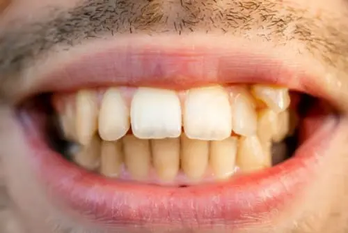 A close-up of a man's teeth showing a single white crown contrasting against discoloured surrounding teeth