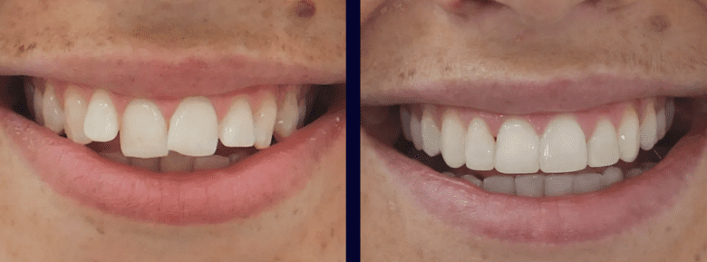 Composite bonding comparison