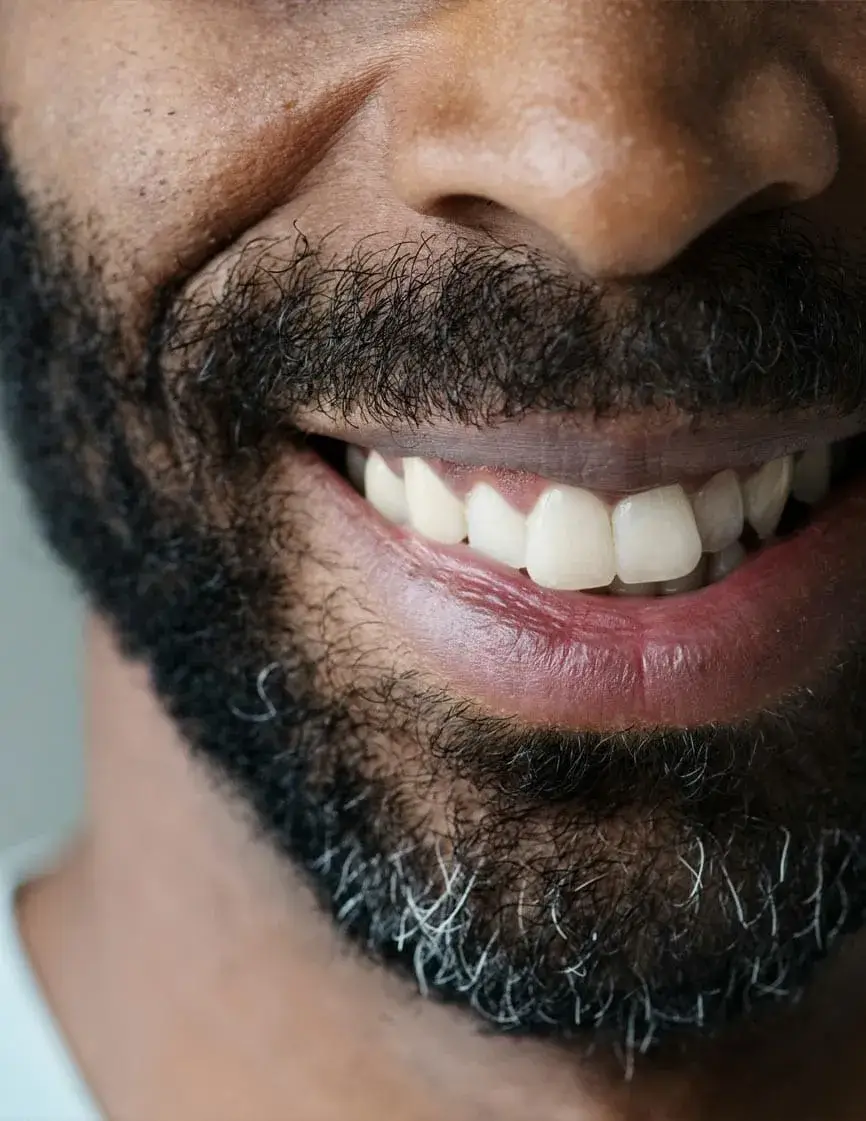 All on Four dental implants